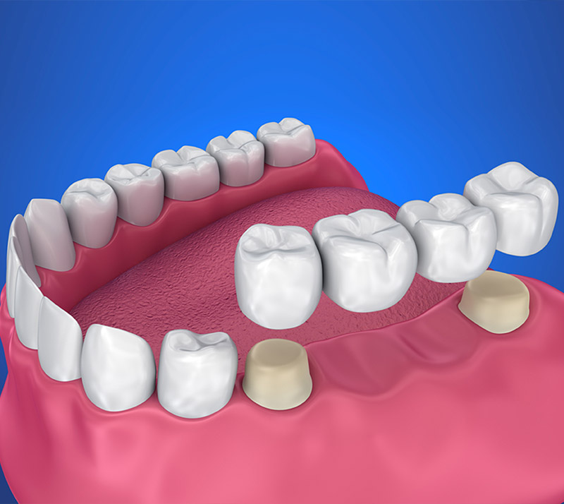 Dental Bridges in Spruce Grove