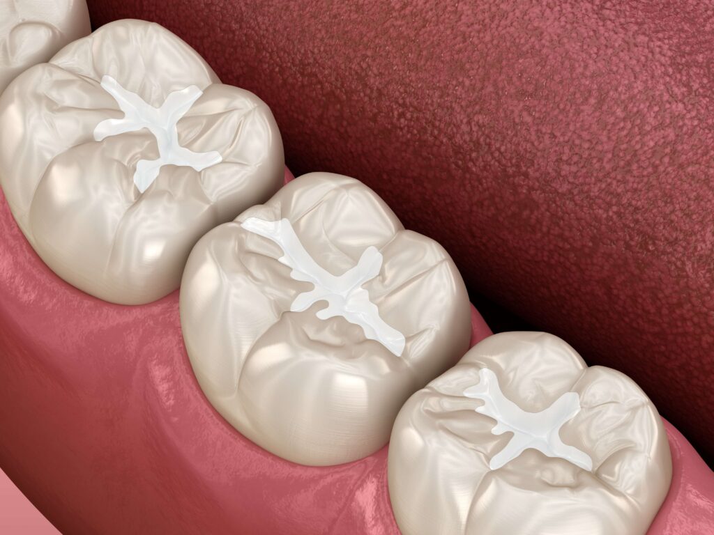 The Process of Composite Dental Filling Removal and Replacement