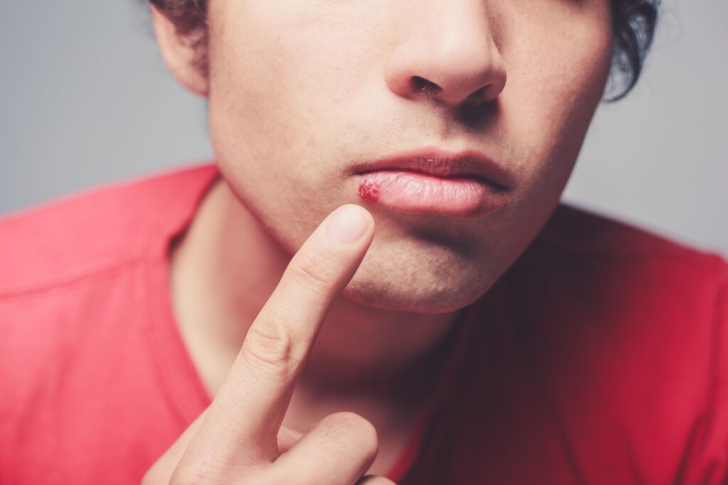 Effective Cold Sore Treatment: Tips, Remedies, and Prevention