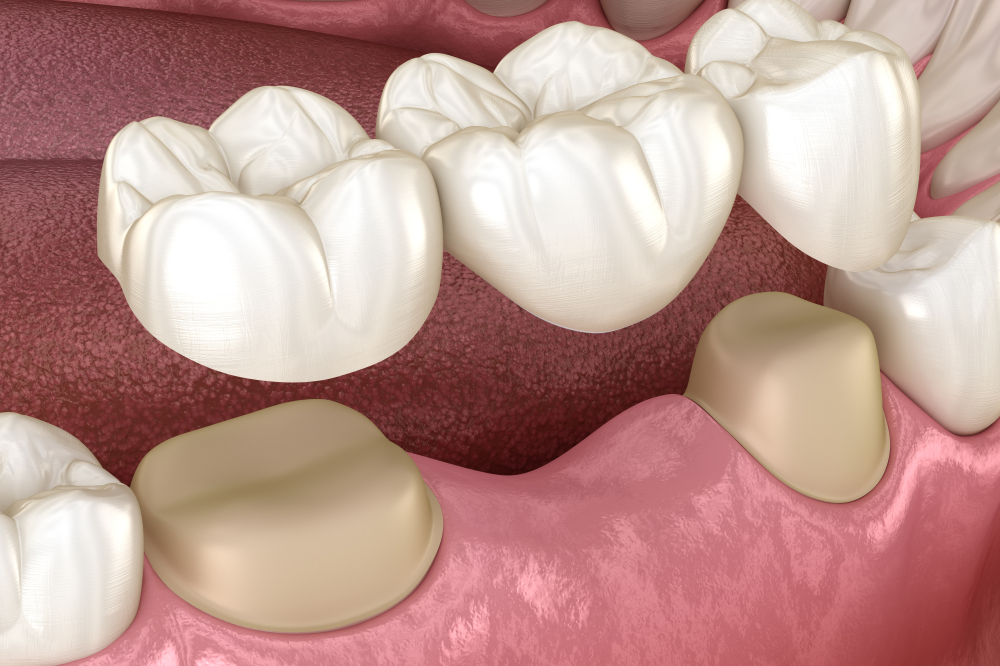 what are the benefits of dental bridges