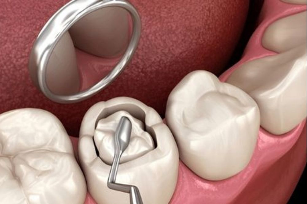 composite dental fillings in Spruce Grove