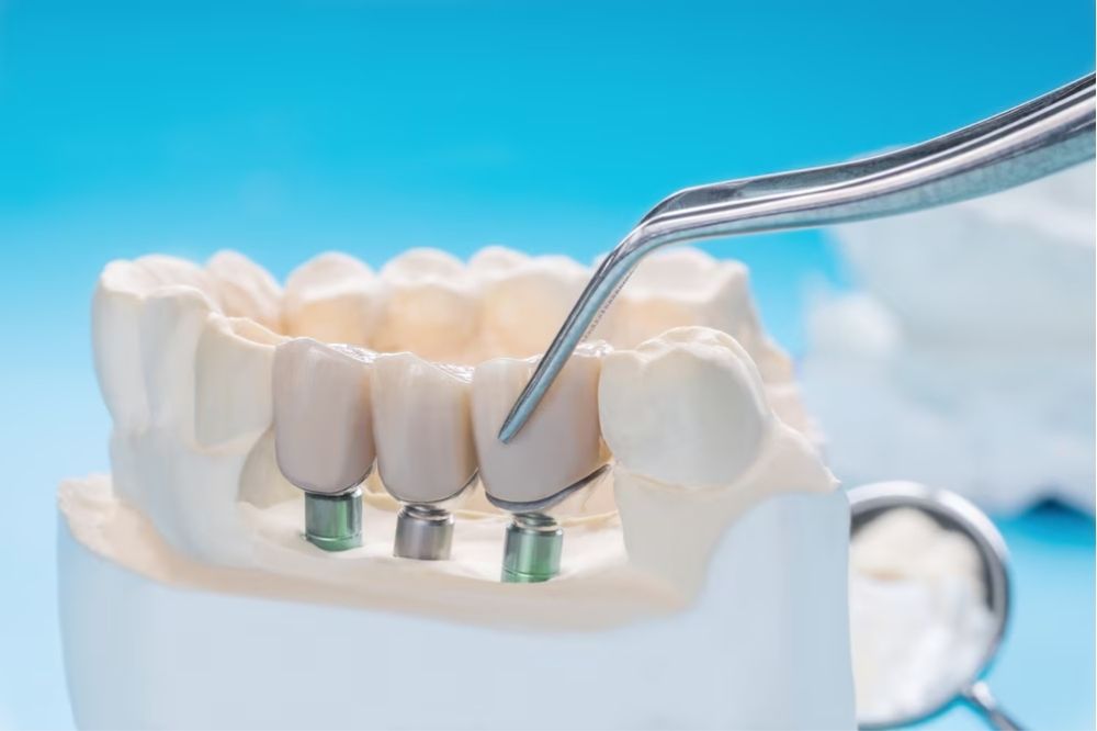 dental bridges in Spruce Grove what foods should you avoid